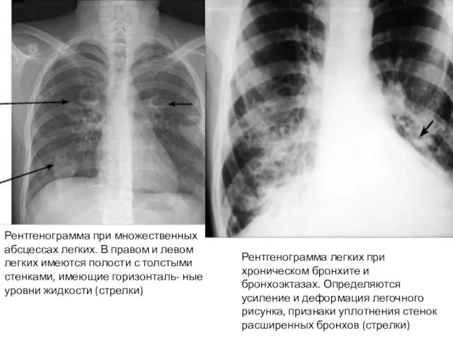 Рентгенограмма при множественных абсцессах легких. В правом и левом легких имеются полости с