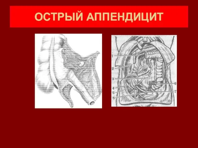 ОСТРЫЙ АППЕНДИЦИТ