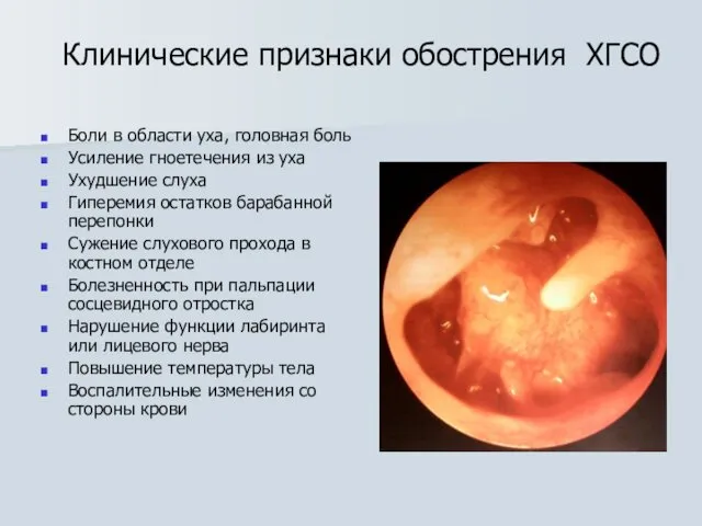 Клинические признаки обострения ХГСО Боли в области уха, головная боль
