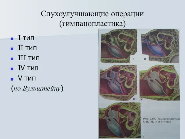 Слухоулучшающие операции (тимпанопластика) I тип II тип III тип IV тип V тип (по Вульштейну)