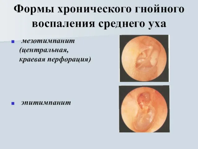 Формы хронического гнойного воспаления среднего уха мезотимпанит (центральная, краевая перфорация) эпитимпанит