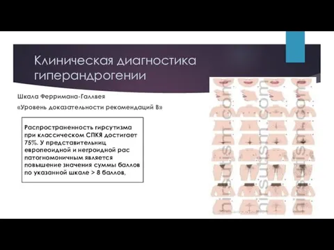 Клиническая диагностика гиперандрогении Шкала Ферримана-Галлвея «Уровень доказательности рекомендаций В» Распространенность