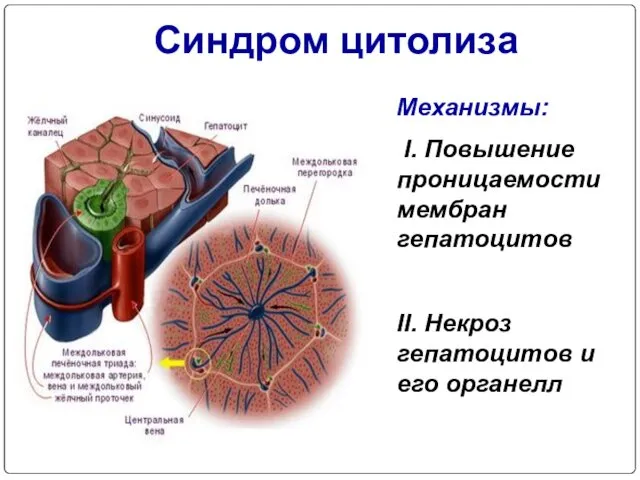 Синдром цитолиза Механизмы: I. Повышение проницаемости мембран гепатоцитов II. Некроз гепатоцитов и его органелл