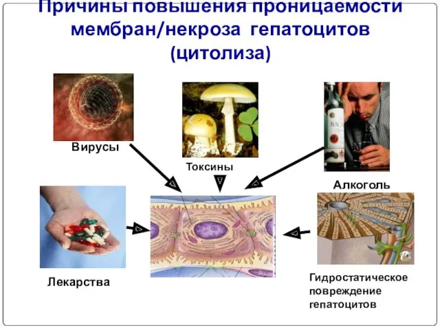 Причины повышения проницаемости мембран/некроза гепатоцитов (цитолиза) Вирусы Токсины Лекарства Алкоголь Гидростатическое повреждение гепатоцитов