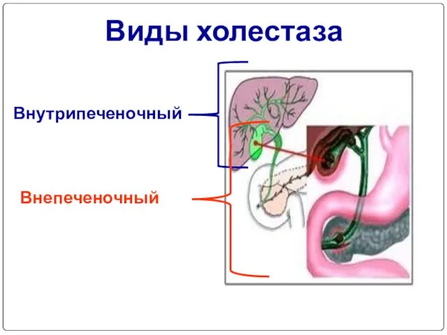 Виды холестаза Внутрипеченочный Внепеченочный