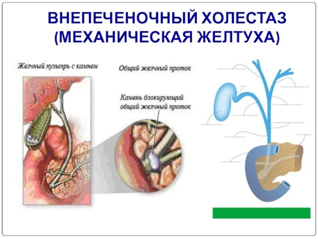 ВНЕПЕЧЕНОЧНЫЙ ХОЛЕСТАЗ (МЕХАНИЧЕСКАЯ ЖЕЛТУХА)