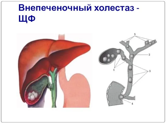 Внепеченочный холестаз - ЩФ