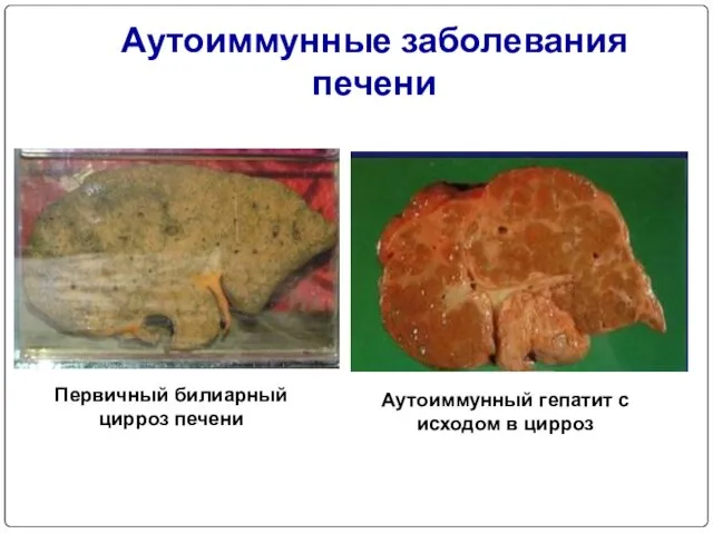 Аутоиммунные заболевания печени Первичный билиарный цирроз печени Аутоиммунный гепатит с исходом в цирроз