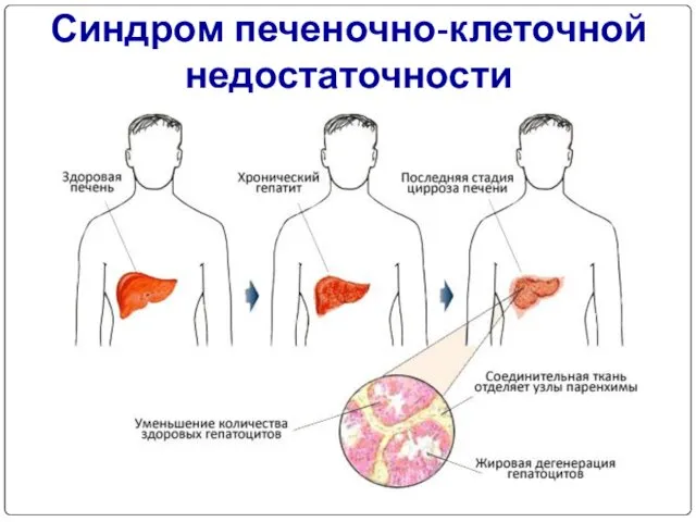 Синдром печеночно-клеточной недостаточности