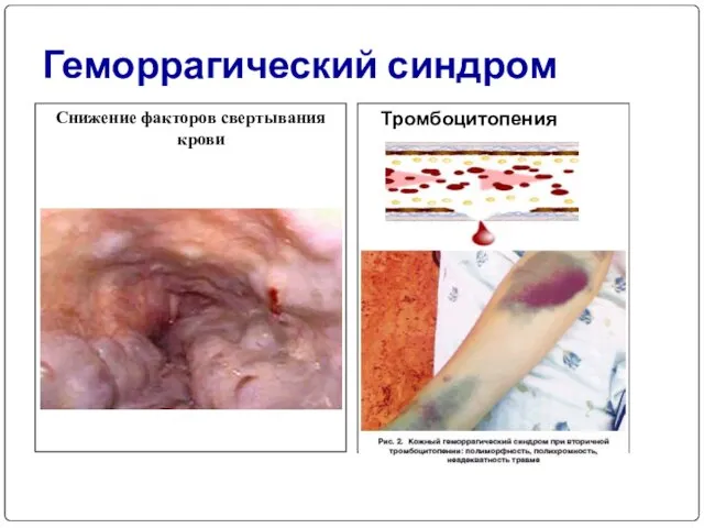 Геморрагический синдром Тромбоцитопения Снижение факторов свертывания крови