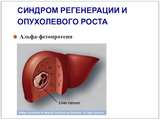 СИНДРОМ РЕГЕНЕРАЦИИ И ОПУХОЛЕВОГО РОСТА Альфа-фетопротеин