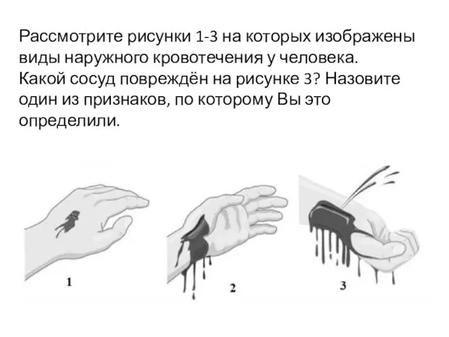 Рассмотрите рисунки 1-3 на которых изображены виды наружного кровотечения у человека. Какой сосуд