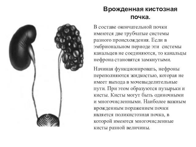 Врожденная кистозная почка. В составе окончательной почки имеются две трубчатые