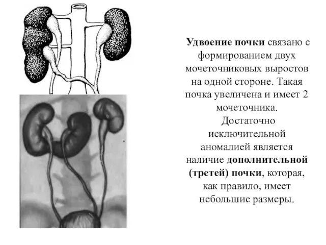 Удвоение почки связано с формированием двух мочеточниковых выростов на одной