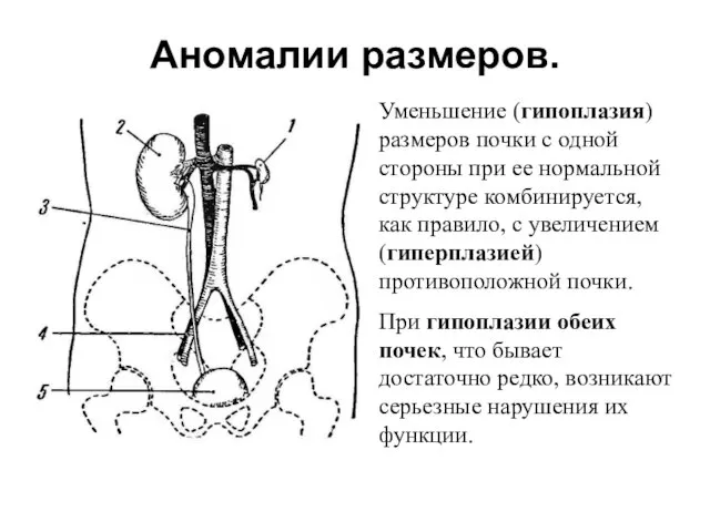 Аномалии размеров. Уменьшение (гипоплазия) размеров почки с одной стороны при