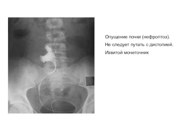 Опущение почки (нефроптоз). Не следует путать с дистопией. Извитой мочеточник