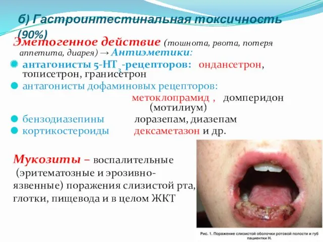 б) Гастроинтестинальная токсичность (90%) Эметогенное действие (тошнота, рвота, потеря аппетита,