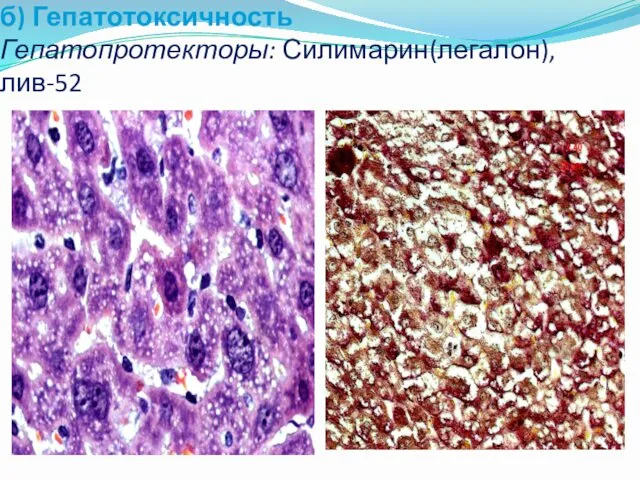 б) Гепатотоксичность Гепатопротекторы: Силимарин(легалон), лив-52