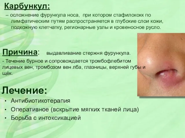 Карбункул: – осложнение фурункула носа, при котором стафилококк по лимфатическим