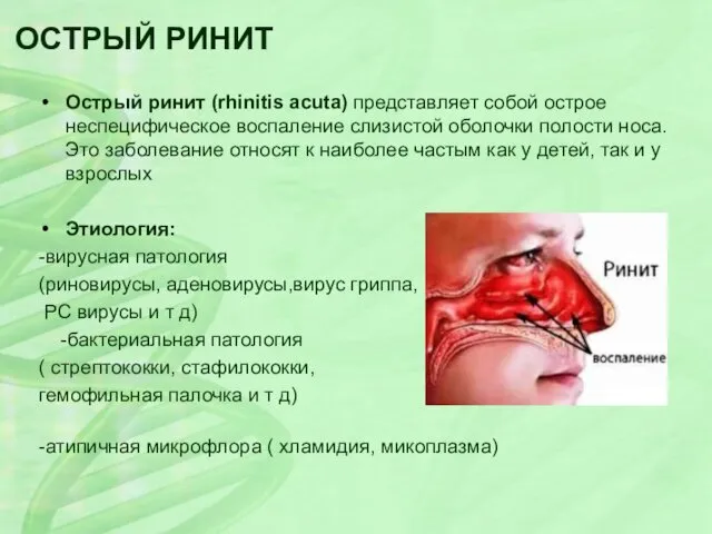 ОСТРЫЙ РИНИТ Острый ринит (rhinitis acuta) представляет собой острое неспецифическое