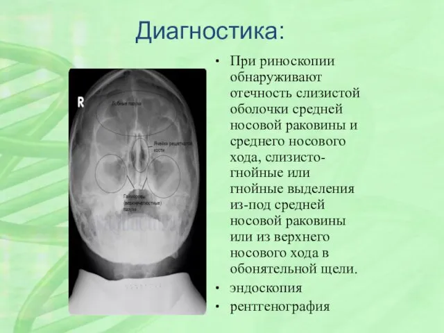 Диагностика: При риноскопии обнаруживают отечность слизистой оболочки средней носовой раковины