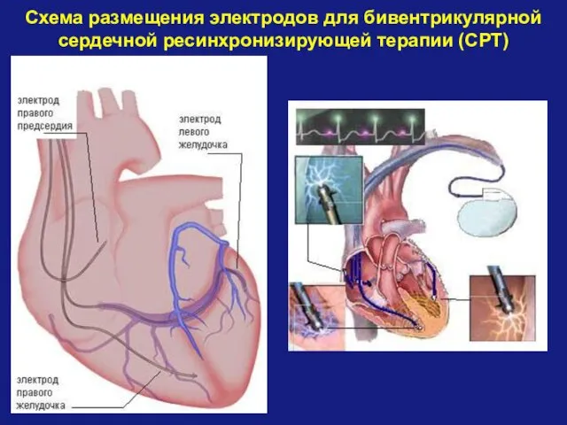 Схема размещения электродов для бивентрикулярной сердечной ресинхронизирующей терапии (СРТ)