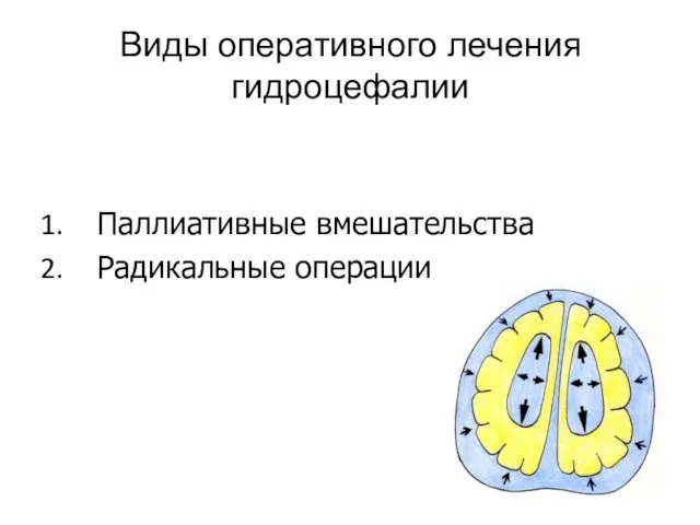 Виды оперативного лечения гидроцефалии Паллиативные вмешательства Радикальные операции