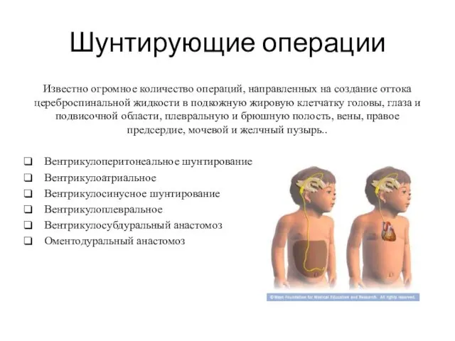 Шунтирующие операции Известно огромное количество операций, направленных на создание оттока цереброспинальной жидкости в