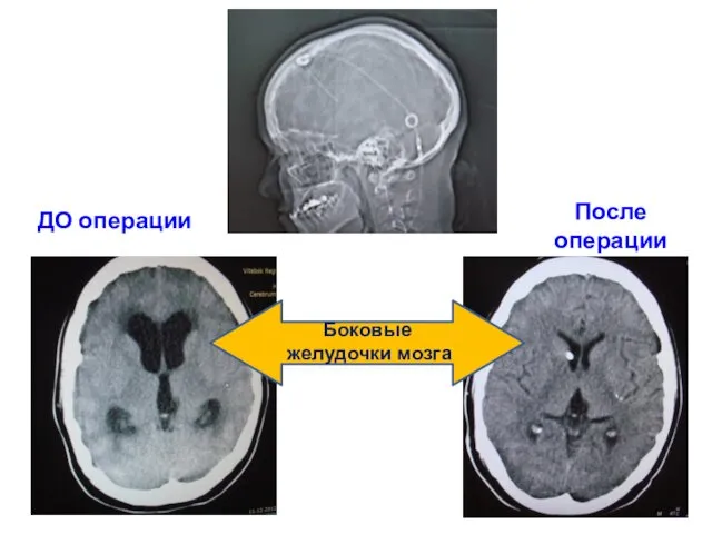 ДО операции После операции Боковые желудочки мозга