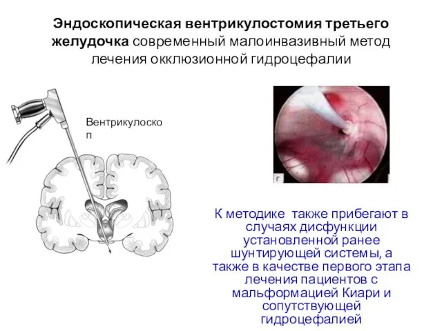 Эндоскопическая вентрикулостомия третьего желудочка современный малоинвазивный метод лечения окклюзионной гидроцефалии К методике также