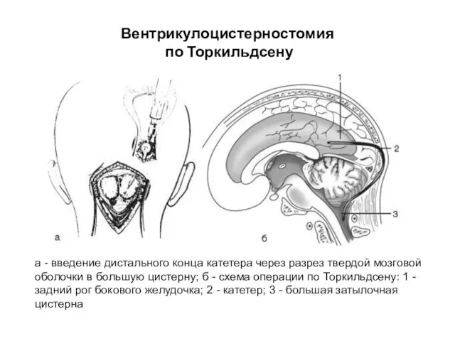 Вентрикулоцистерностомия по Торкильдсену а - введение дистального конца катетера через разрез твердой мозговой