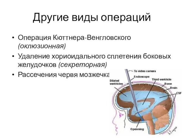Другие виды операций Операция Кюттнера-Венгловского (оклюзионная) Удаление хориоидального сплетения боковых желудочков (секреторная) Рассечения червя мозжечка