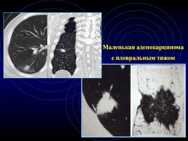 Маленькая аденокарцинома с плевральным тяжом