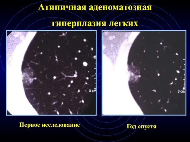 Атипичная аденоматозная гиперплазия легких Первое исследование Год спустя