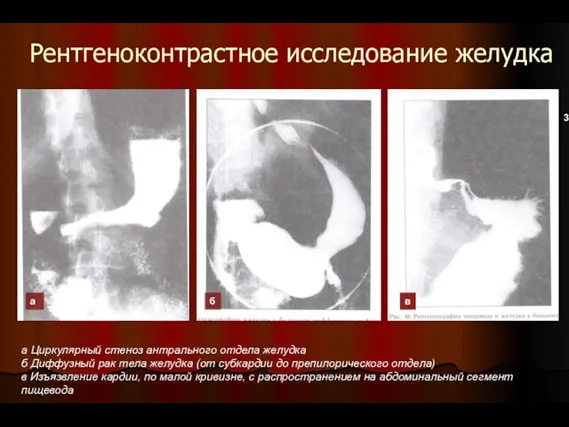 Рентгеноконтрастное исследование желудка а Циркулярный стеноз антрального отдела желудка б Диффузный рак тела