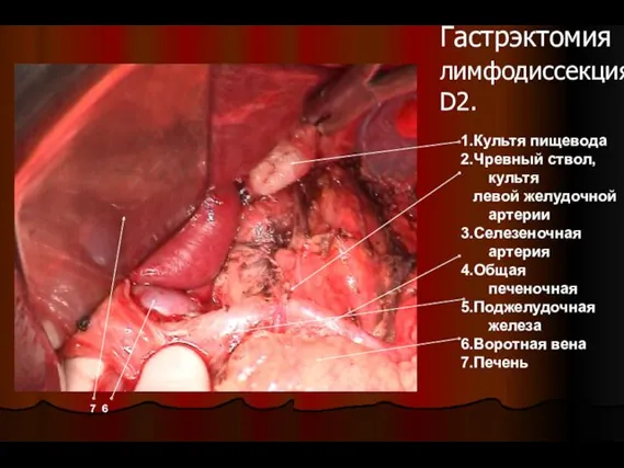Гастрэктомия лимфодиссекция D2. 1.Культя пищевода 2.Чревный ствол, культя левой желудочной артерии 3.Селезеночная артерия