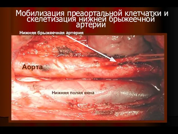 Мобилизация преаортальной клетчатки и скелетизация нижней брыжеечной артерии Аорта Нижняя полая вена Нижняя брыжеечная артерия