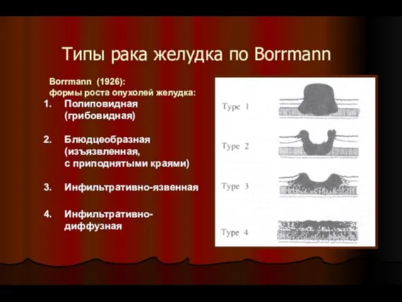 Типы рака желудка по Borrmann Borrmann (1926): формы роста опухолей желудка: Полиповидная (грибовидная)