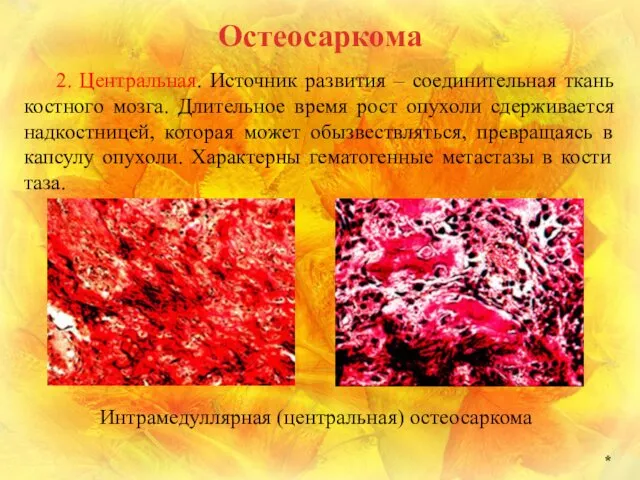 * Остеосаркома 2. Центральная. Источник развития – соединительная ткань костного