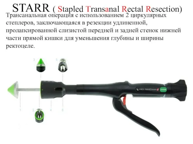 STARR ( Stapled Transanal Rectal Resection) Трансанальная операция с использованием