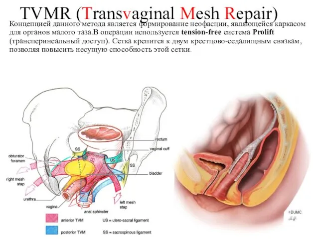 TVMR (Transvaginal Mesh Repair) Концепцией данного метода является формирование неофасции,