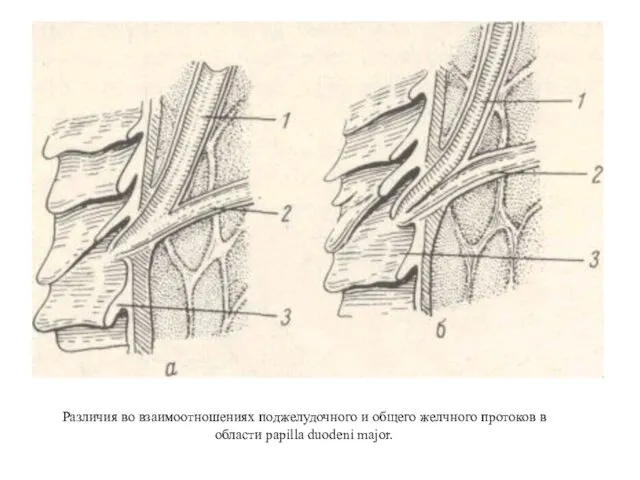Различия во взаимоотношениях поджелудочного и общего желчного протоков в области papilla duodeni major.