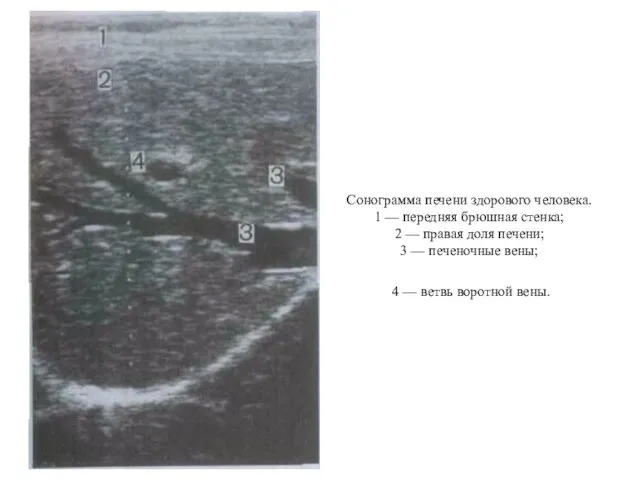 Сонограмма печени здорового человека. 1 — передняя брюшная стенка; 2