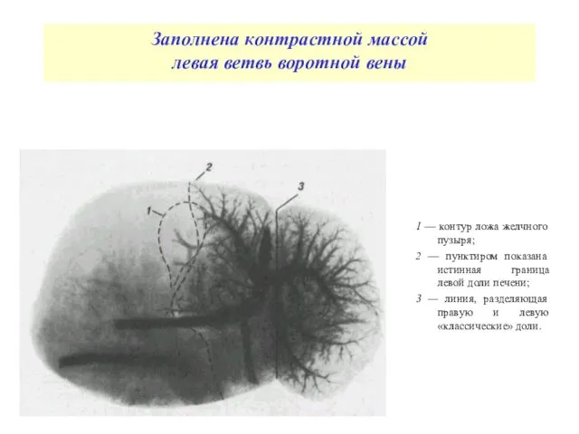 Заполнена контрастной массой левая ветвь воротной вены 1 — контур