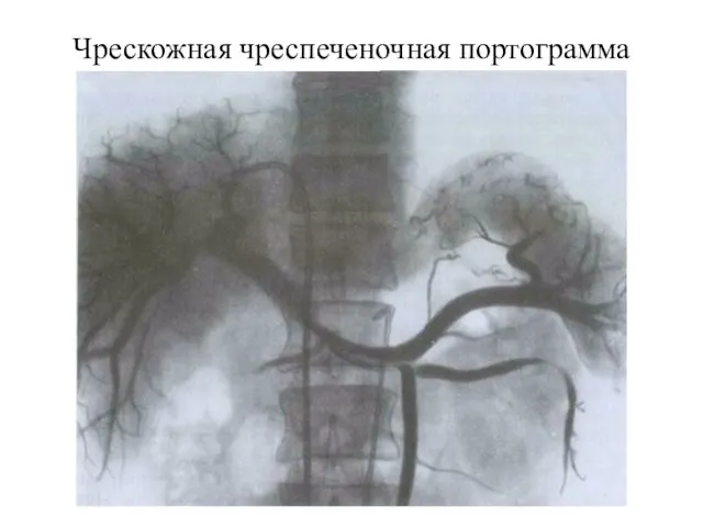 Чрескожная чреспеченочная портограмма