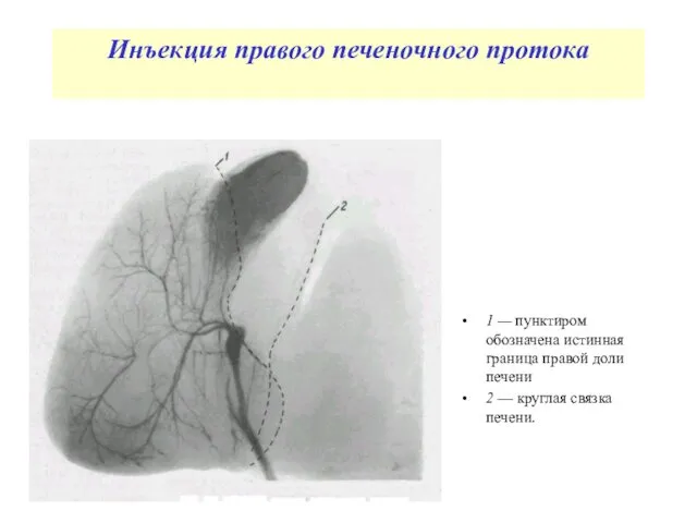 Инъекция правого печеночного протока 1 — пунктиром обозначена истинная граница