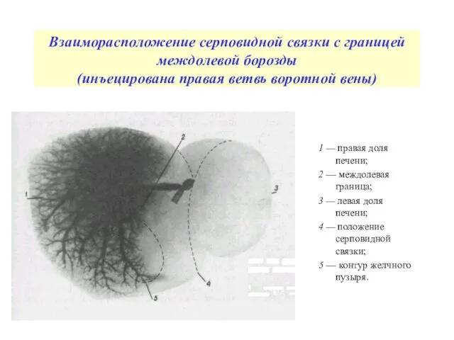 Взаиморасположение серповидной связки с границей междолевой борозды (инъецирована правая ветвь