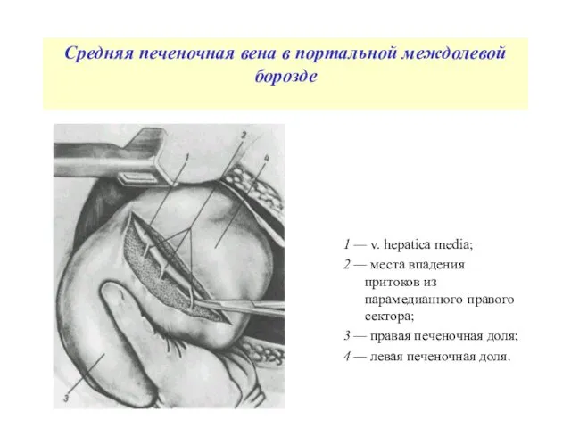 Средняя печеночная вена в портальной междолевой борозде 1 — v.