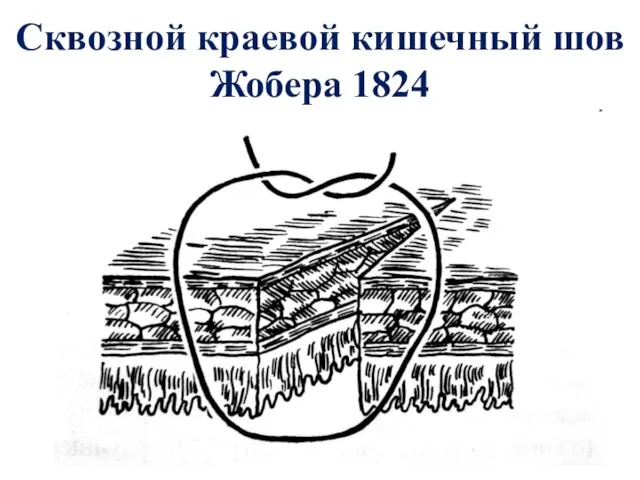 Сквозной краевой кишечный шов Жобера 1824