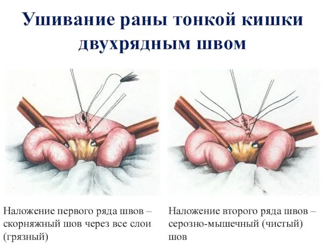 Ушивание раны тонкой кишки двухрядным швом Наложение первого ряда швов – скорняжный шов